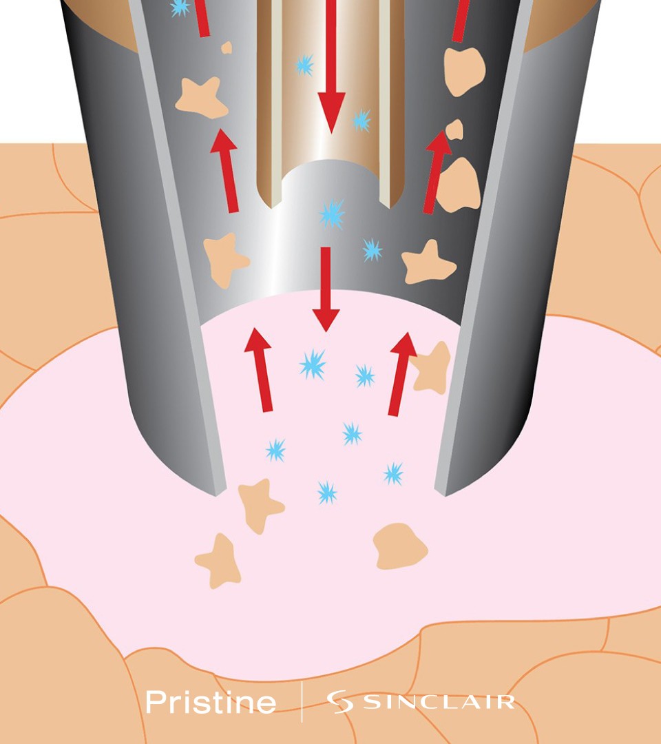 Modul de Functionare al Microdermabraziunii cu Echipamentul Pristine de la Sinclair