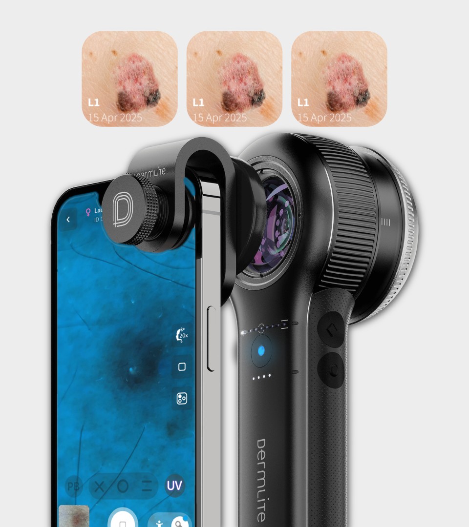 DermLite DL5 Plus FotoFinder - Compararea Imaginilor si Monitorizarea in Timp a Leziunilor Cutanate