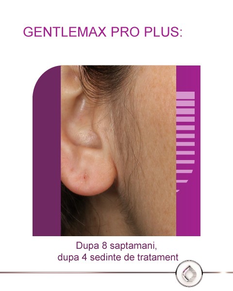 Dupa Tratament GentleMax Pro Plus